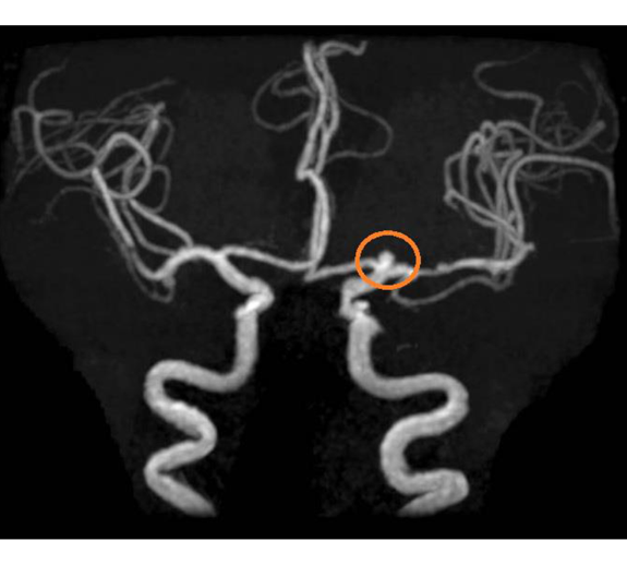 脳動脈瘤（くも膜下出血の原因）