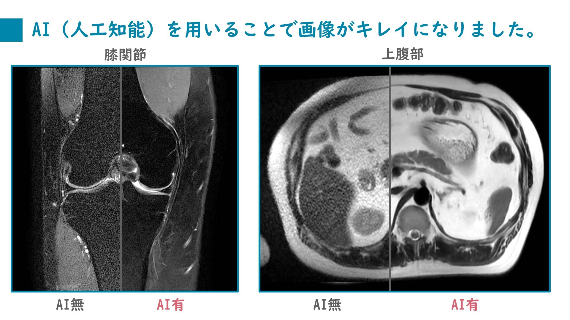 脳ドック MR 